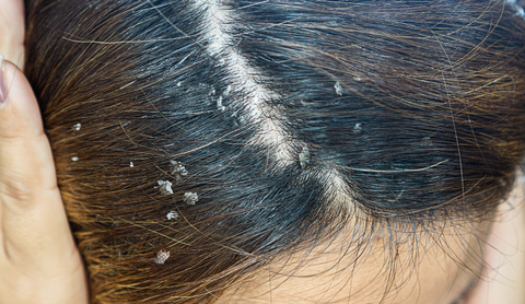 Kontaktni dermatitis lasišča: Kaj morate vedeti o alergijah pri negi las
