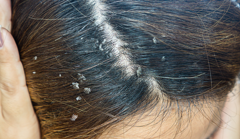 Kontaktni dermatitis lasišča: simptomi, vzroki in kaj storiti